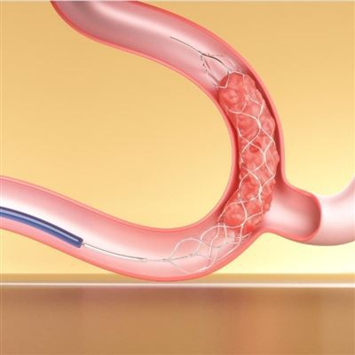 DSA-veiledet Stent Retriever for akutt hjerneinfarkt